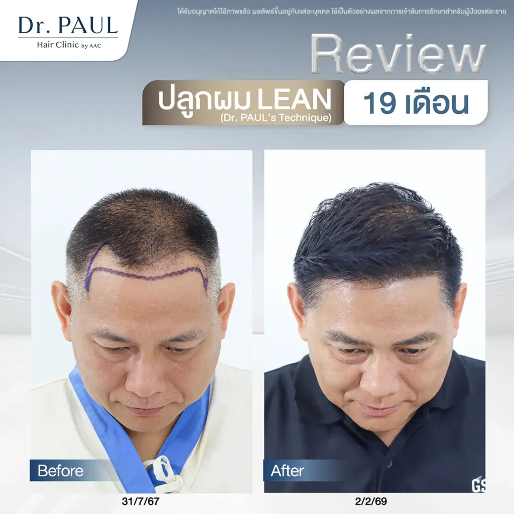 รีวิวปลูกผมคุณผู้ชาย ผ่านไปแล้ว 19 เดือน ผมดูดกหนาเป็นธรรมชาติ