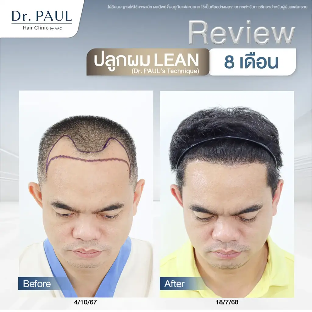 รีวิวเปรียบเทียบก่อน-หลังปลูกผม 8 เดือนในผู้ชาย