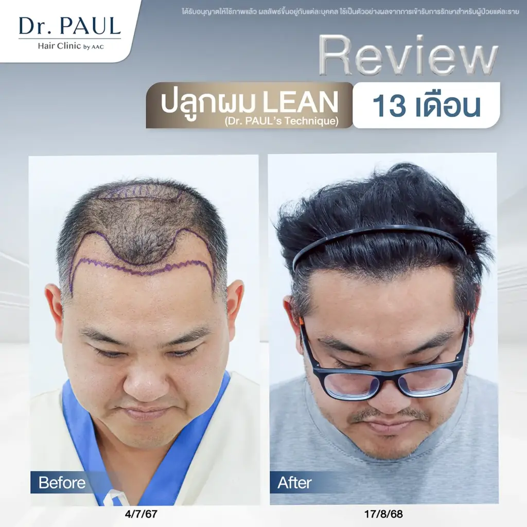 รีวิวปลูกผม แก้ผมร่วงผมบางจากกรรมพันธุ์ในผู้ชาย