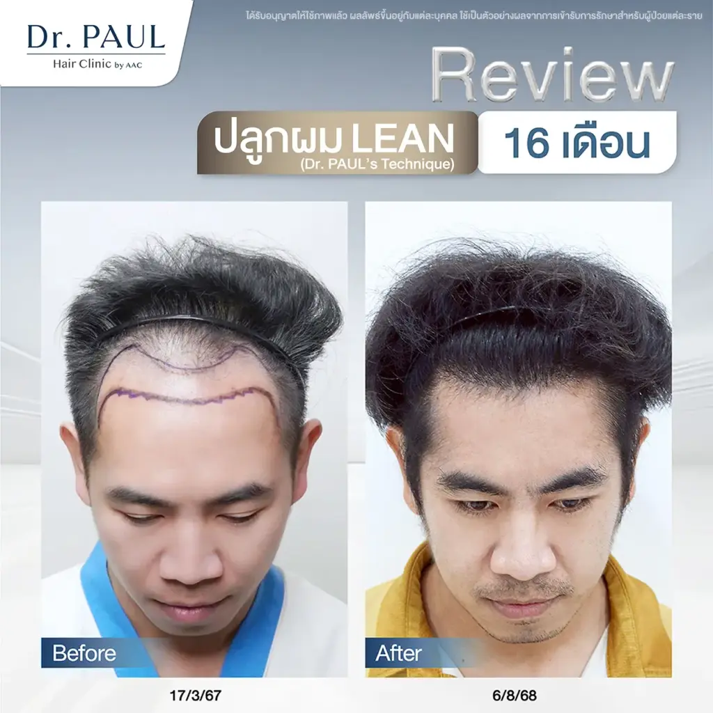 รีวิวปลูกผมผู้ชาย ผมเว้าลึก กลับมาดกหนา หลังผ่านไป 16 เดือน