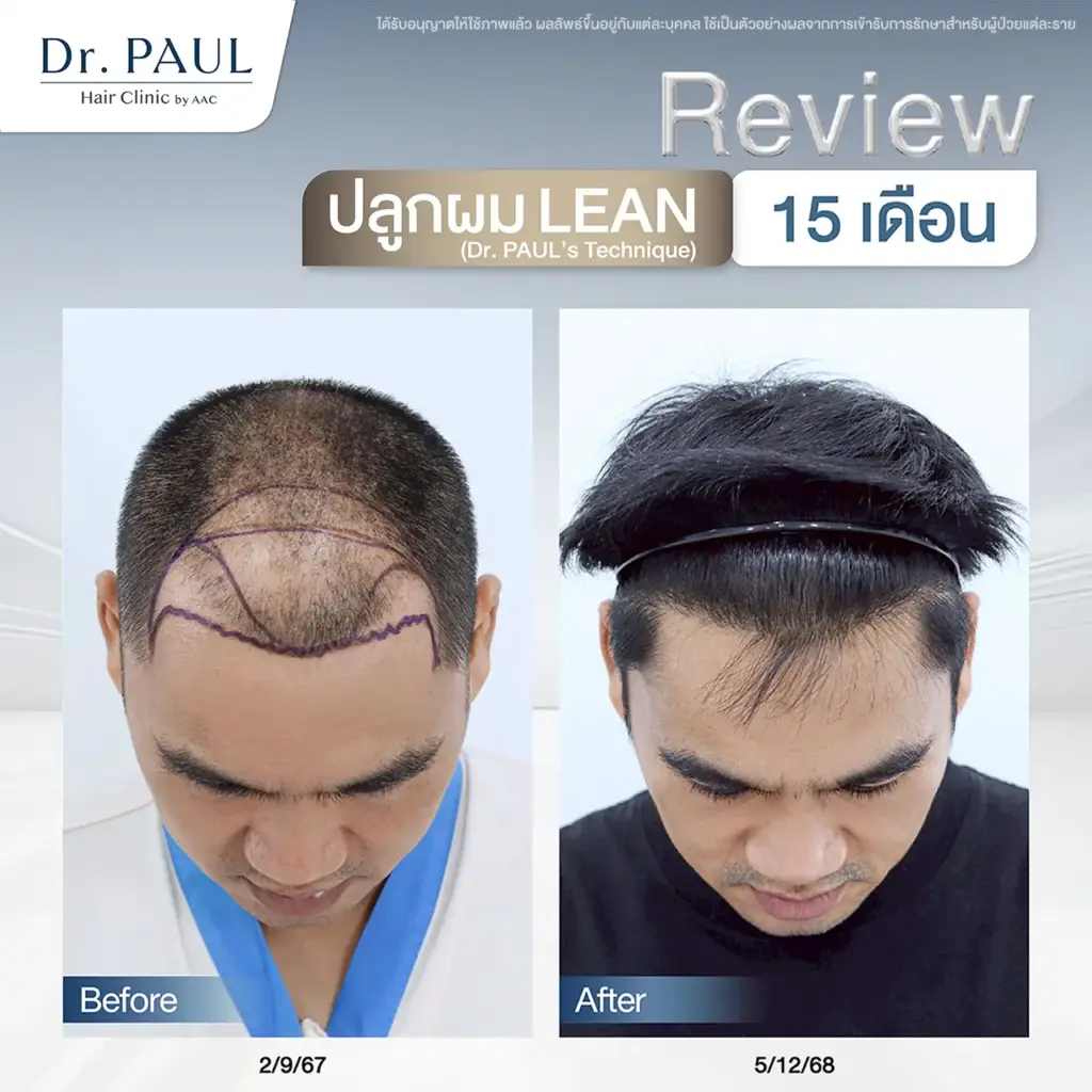 รีวิวปลูกผม ผ่านไปแล้ว 15 เดือน แนวผมกลับมาดูเต็มเป็นธรรมชาติ