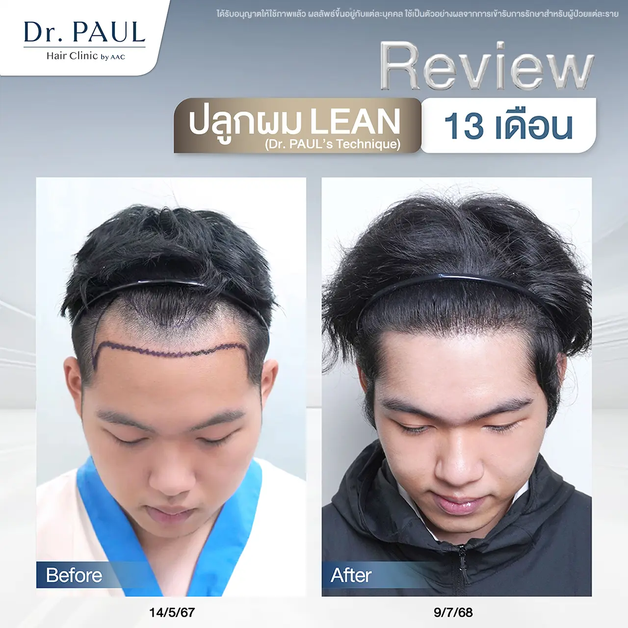 รีวิวปลูกผมในผู้ชาย จากแนวผมถอยร่นเป็นรูปตัวเอ็ม กลับมาเต็มหนาอีกครั้ง