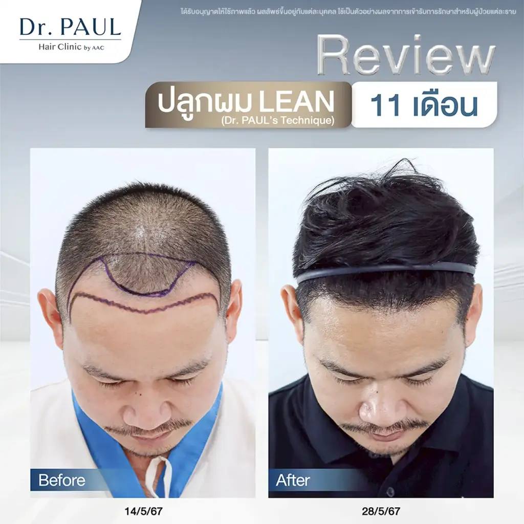 รีวิวหลังปลูกผมผู้ชาย 11 เดือน มั่นใจในผลลัพธ์ที่เป็นธรรมชาติ