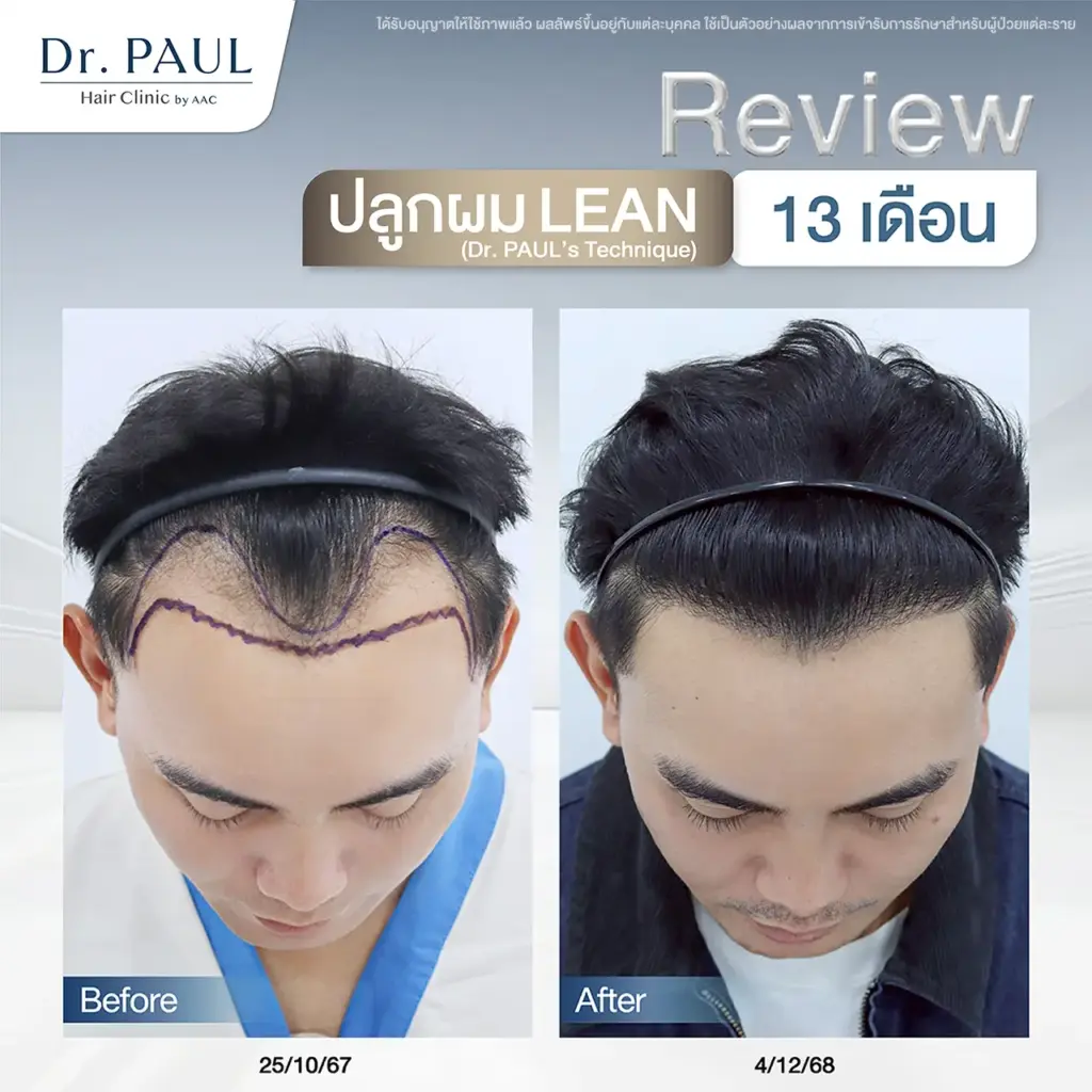 รีวิว หลังปลูกผมมาแล้ว 13 เดือน เคสผู้ชาย