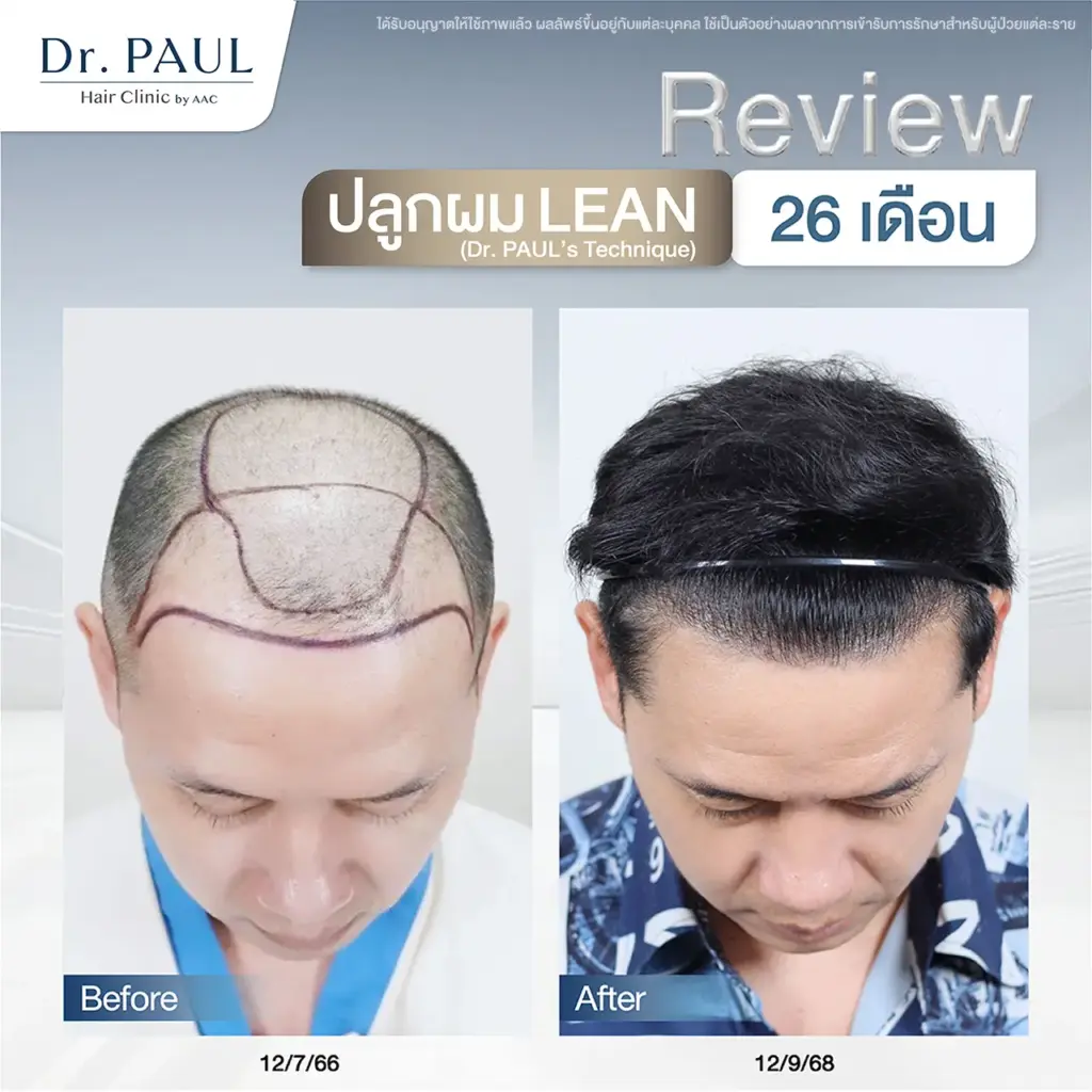 รีวิวผลลัพธ์หลังปลูกผม 26 เดือน (2 ปี 2 เดือน)