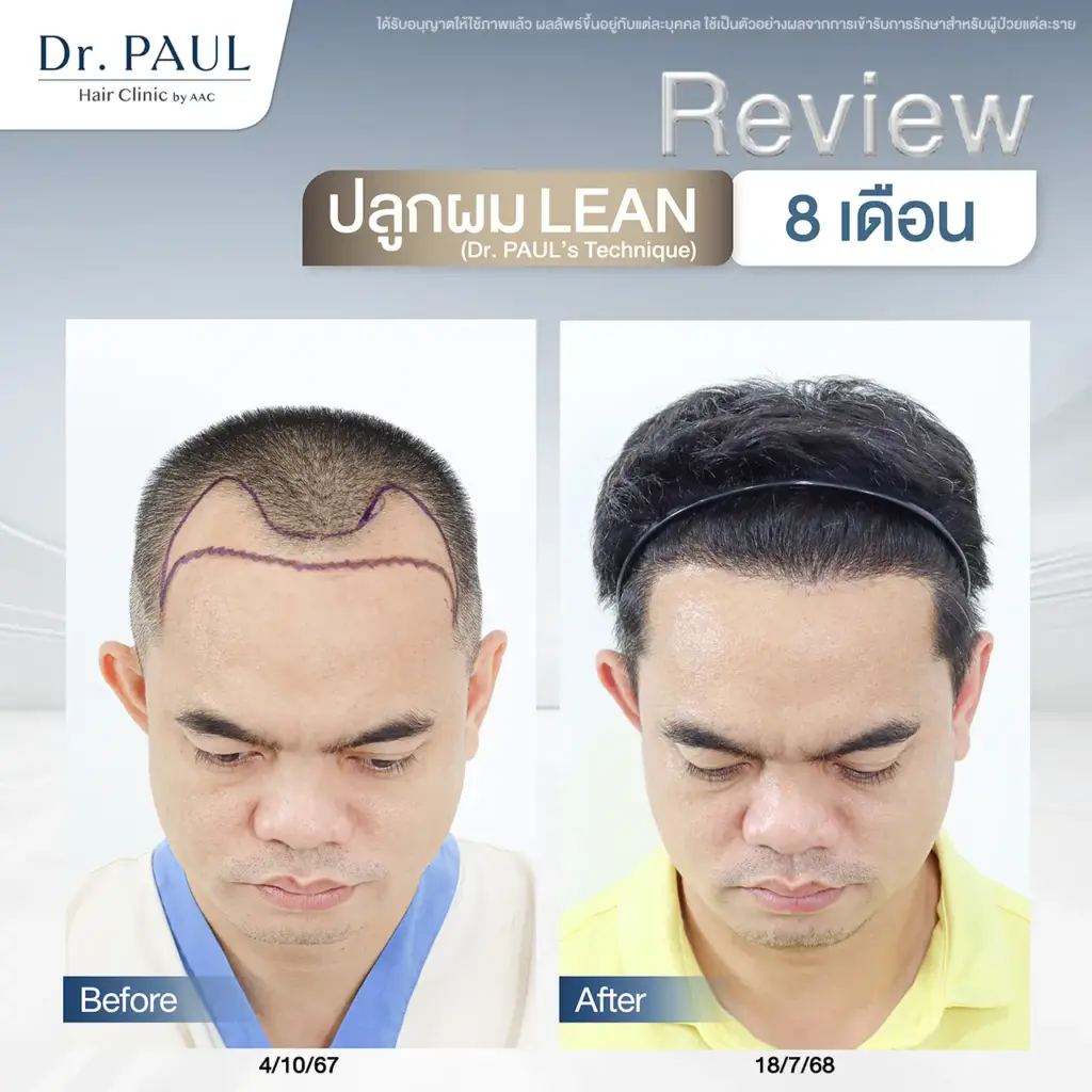รีวิวหลังปลูกผมผู้ชาย 8 เดือน