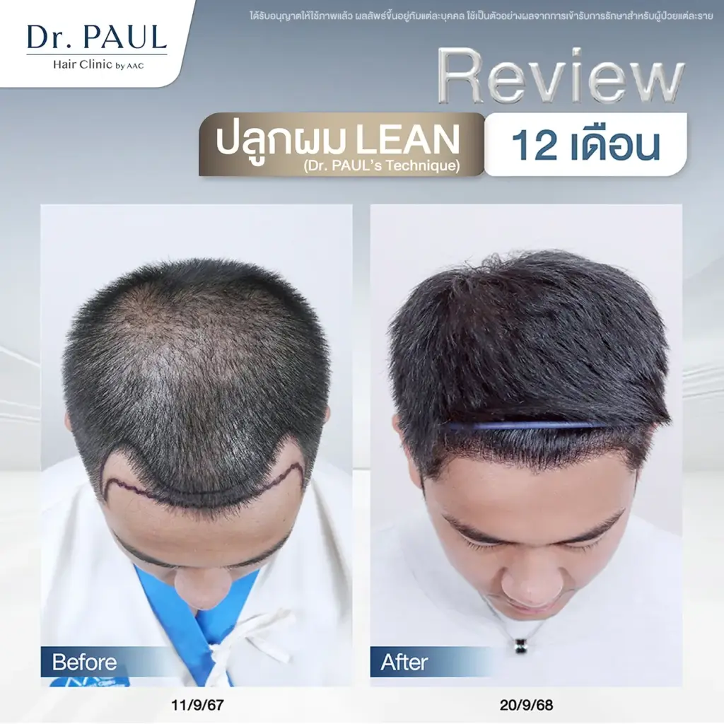 รีวิวเทียบก่อน-หลังปลูกผม 12 เดือน (1 ปี) ในผู้ชาย