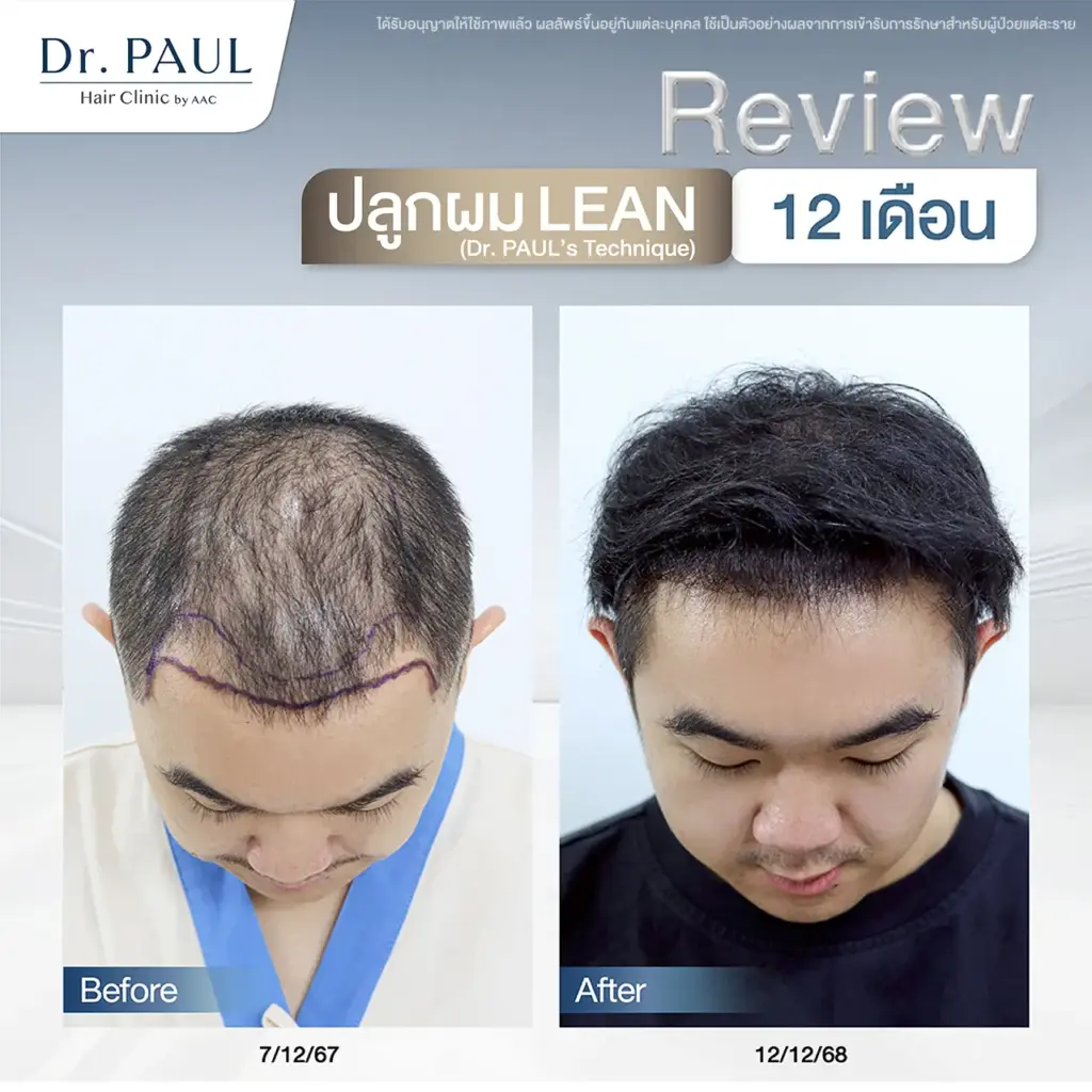 รีวิวผลลัพธ์หลังปลูกผม 12 เดือน