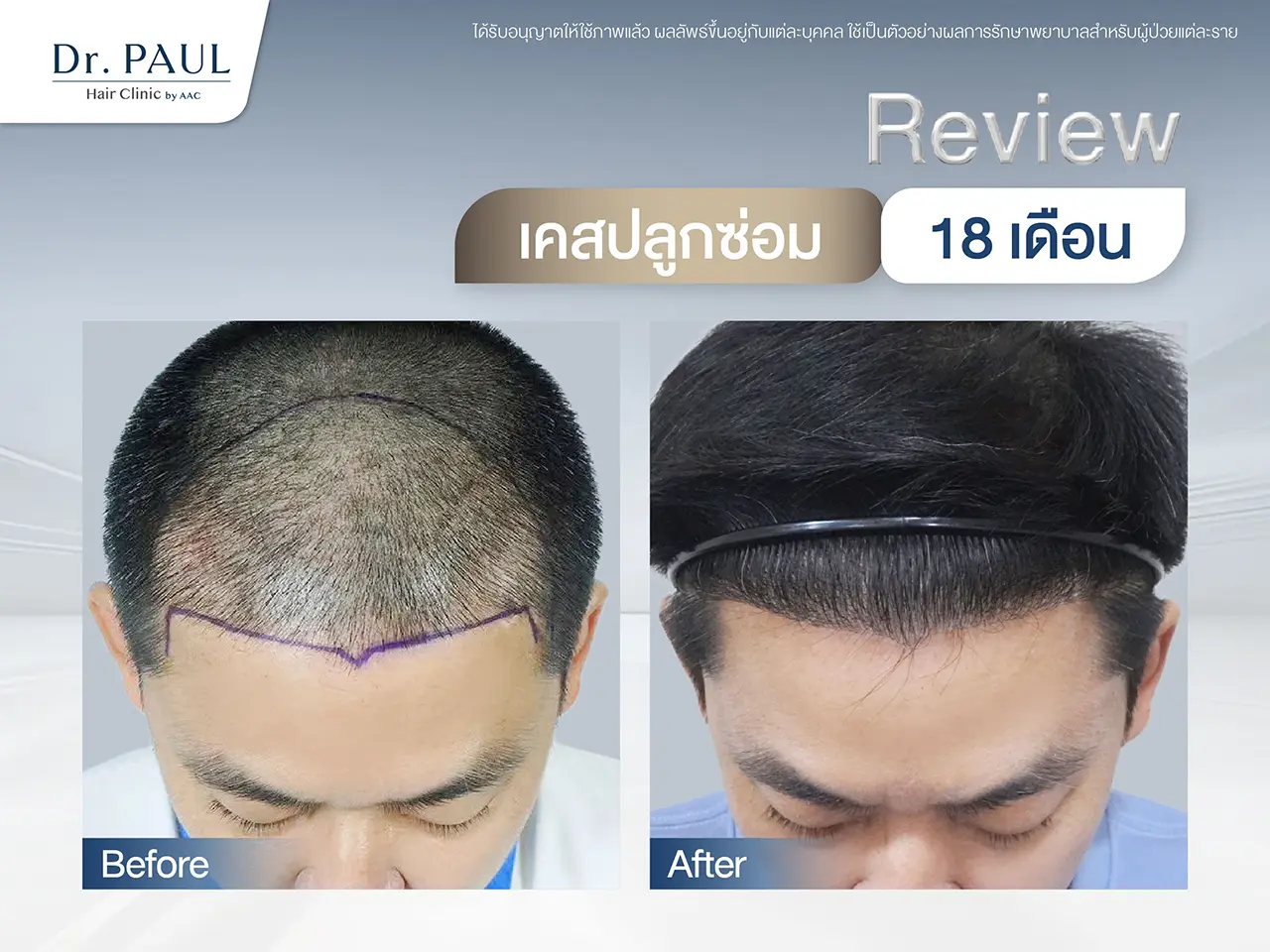 รีวิวปลูกผมรอบ 2 ที่ Dr. PAUL Hair Clinic by AAC