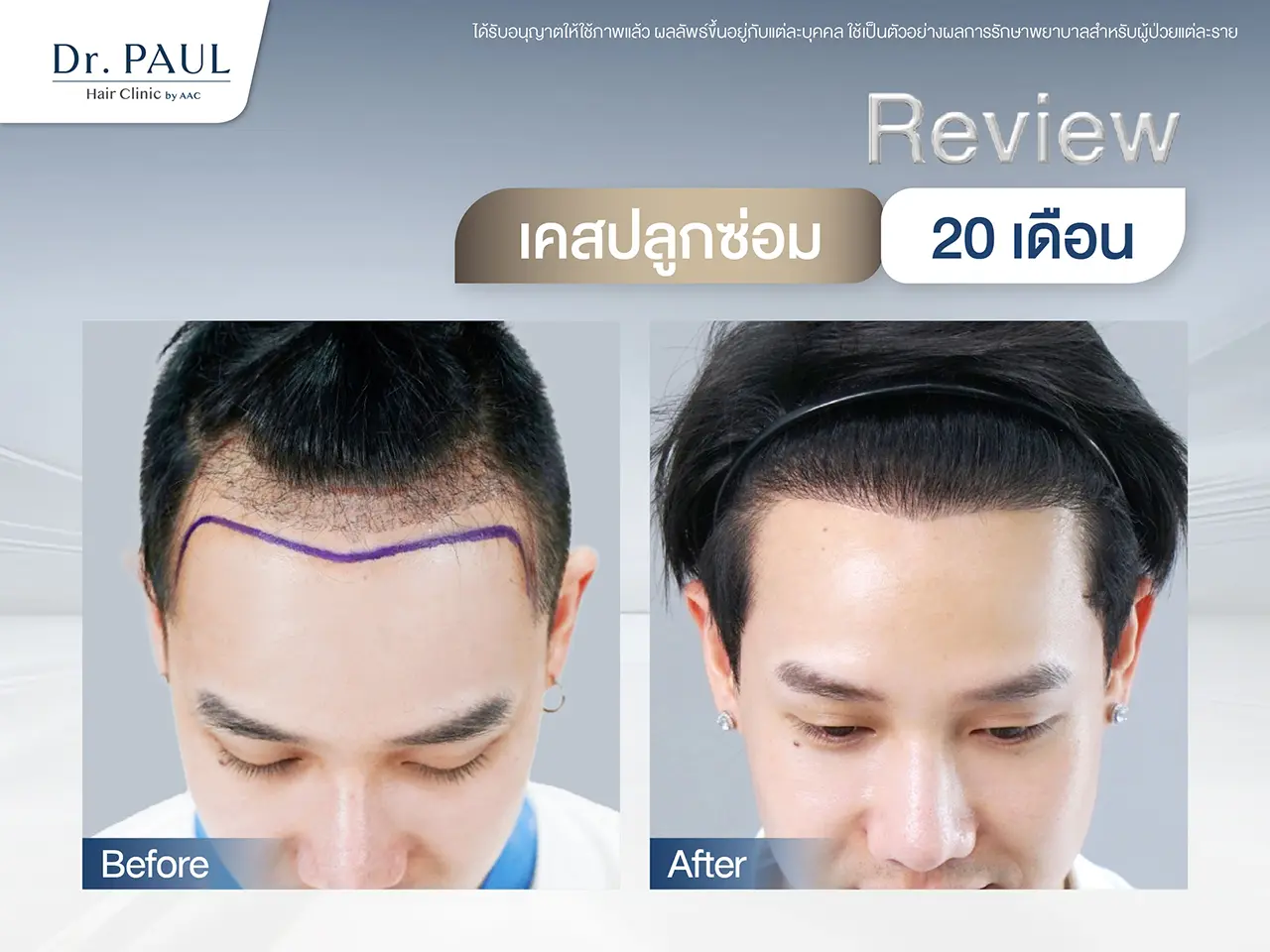 รีวิวปลูกผมรอบ 2 แก้ให้ดูลงตัวเป็นธรรมชาติมากขึ้น