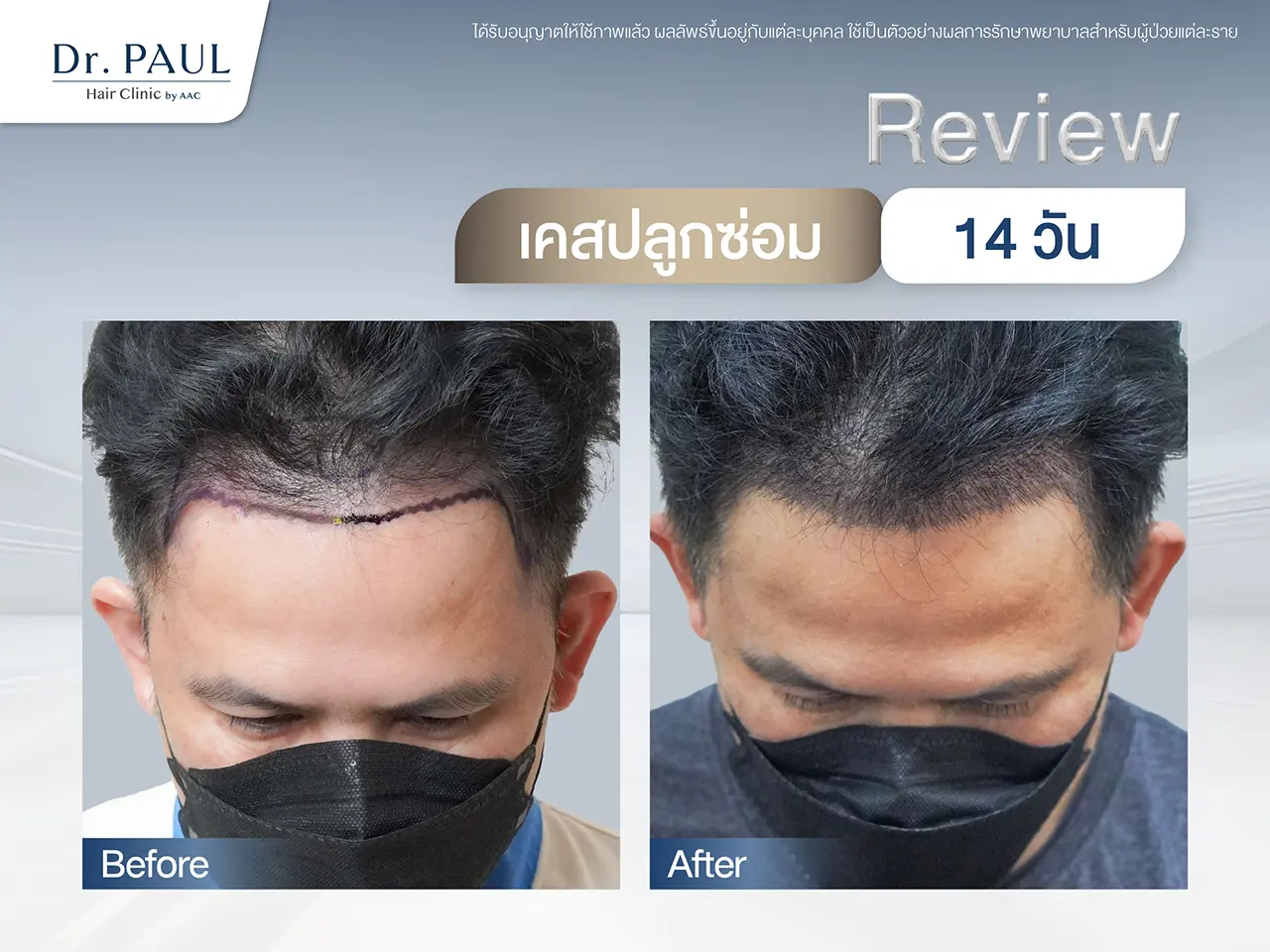 รีวิวปลูกผมซ่อม แก้ผลลัพธ์จากคลินิกอื่น