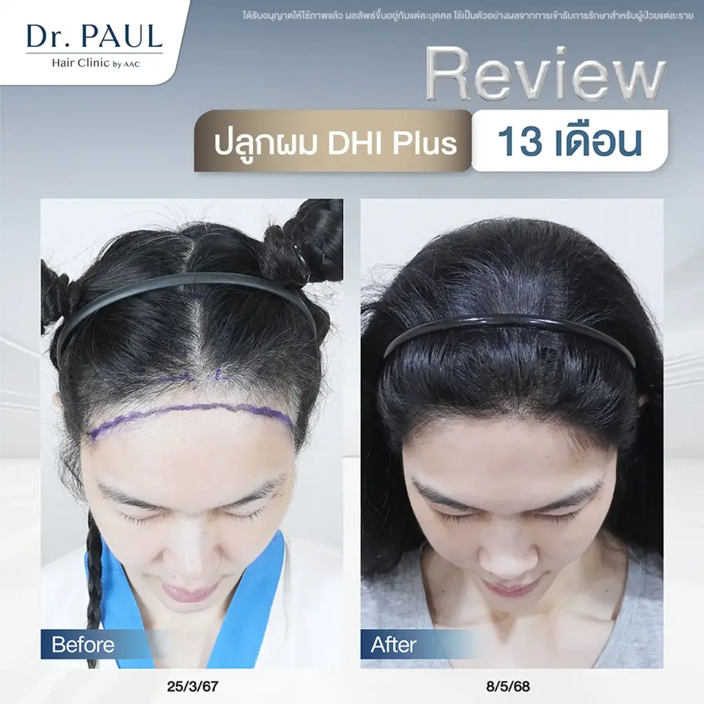 รีวิวปลูกผมผู้หญิงเทคนิค DHI Plus เทียบก่อน-หลัง 13 เดือน รีวิวปลูกผมผู้หญิงเทคนิค DHI Plus เทียบก่อน-หลัง 13 เดือน