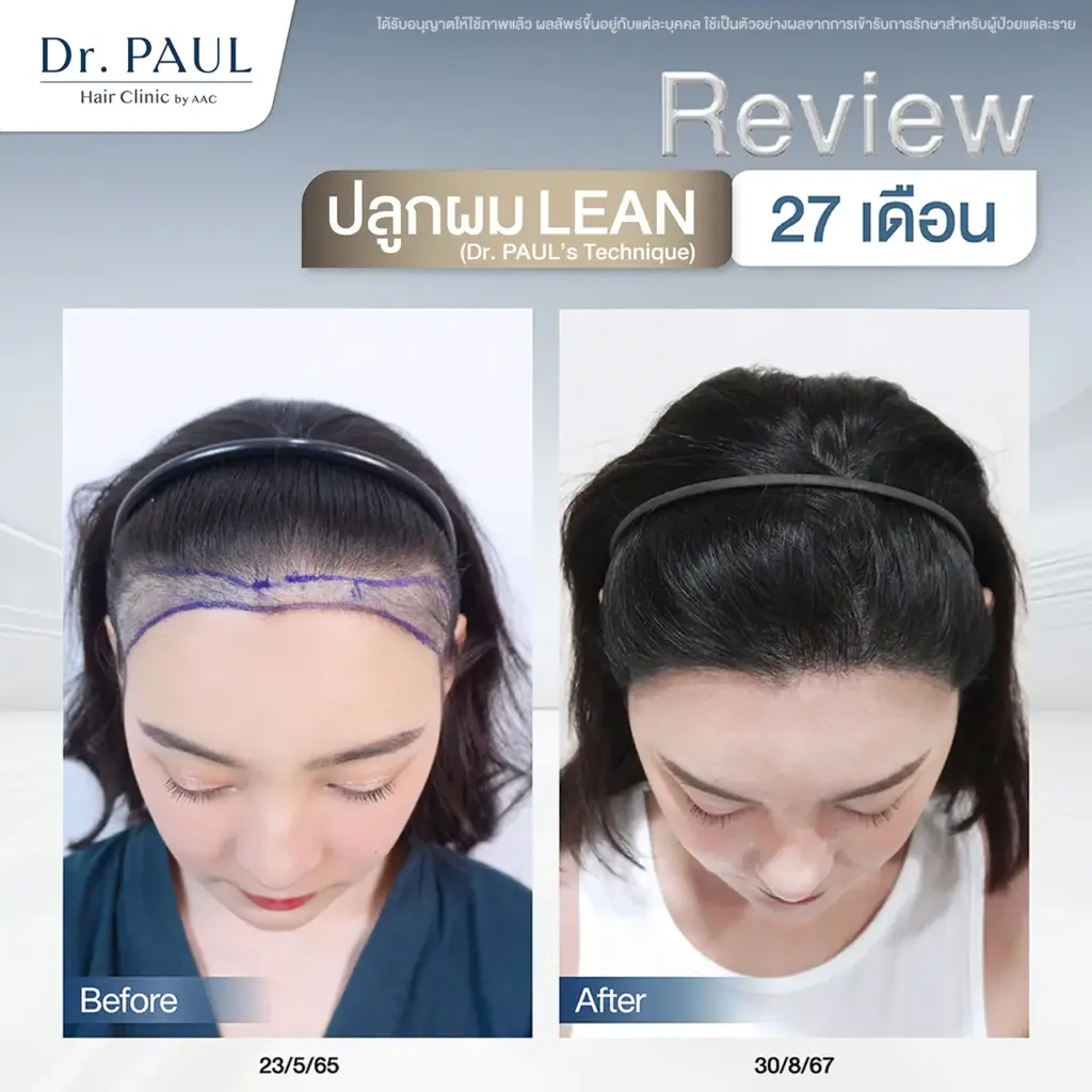 รีวิวปลูกผมผู้หญิงเทคนิค LEAN หลังปลูกครบ 27 เดือน รีวิวปลูกผมผู้หญิงเทคนิค LEAN หลังปลูกครบ 27 เดือน