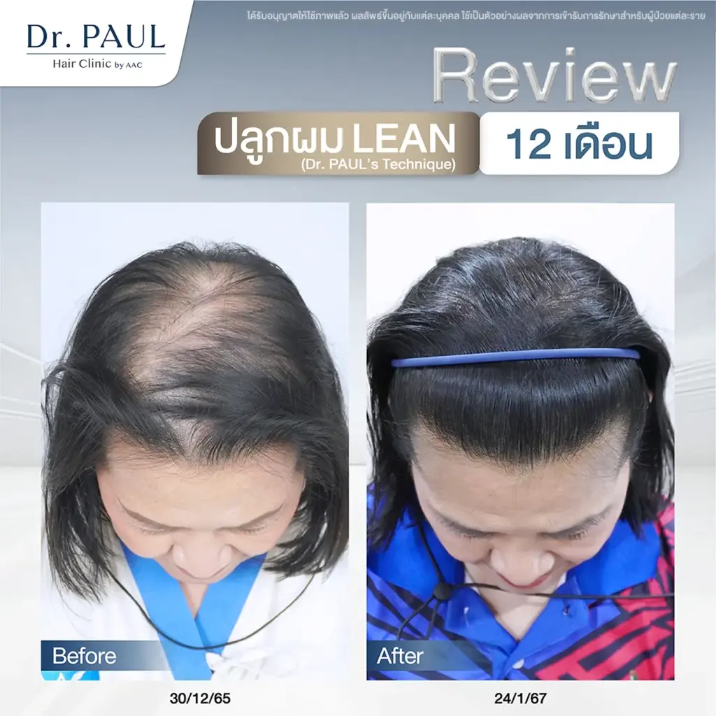 รีวิวหลังปลูกผมในผู้หญิง แก้แสกผมกว้าง ผมบาง เห็นหนังศีรษะ รีวิวหลังปลูกผมในผู้หญิง แก้แสกผมกว้าง ผมบาง เห็นหนังศีรษะ