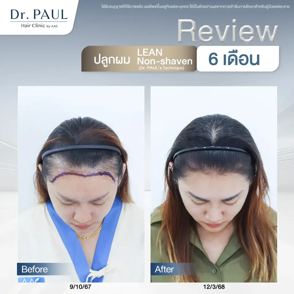 รีวิวปลูกผมผู้หญิง เทคนิคไม่ต้องโกน ผลลัพธ์ที่ 6 เดือน รีวิวปลูกผมผู้หญิง เทคนิคไม่ต้องโกน ผลลัพธ์ที่ 6 เดือน