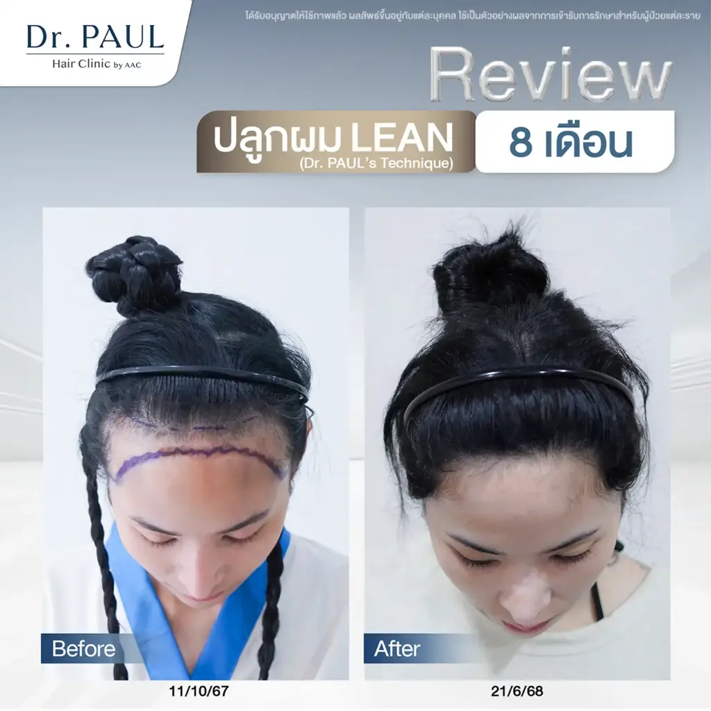 รีวิวปลูกผมผู้หญิง หลัง 8 เดือน รีวิวปลูกผมผู้หญิง หลัง 8 เดือน