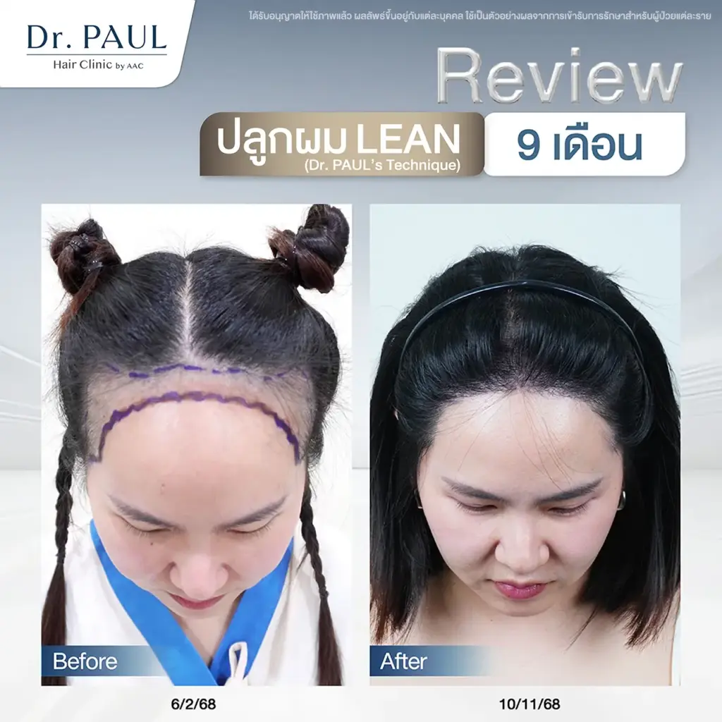 รีวิวปลูกผมผู้หญิง ผลลัพธ์หลัง 9 เดือน รีวิวปลูกผมผู้หญิง ผลลัพธ์หลัง 9 เดือน