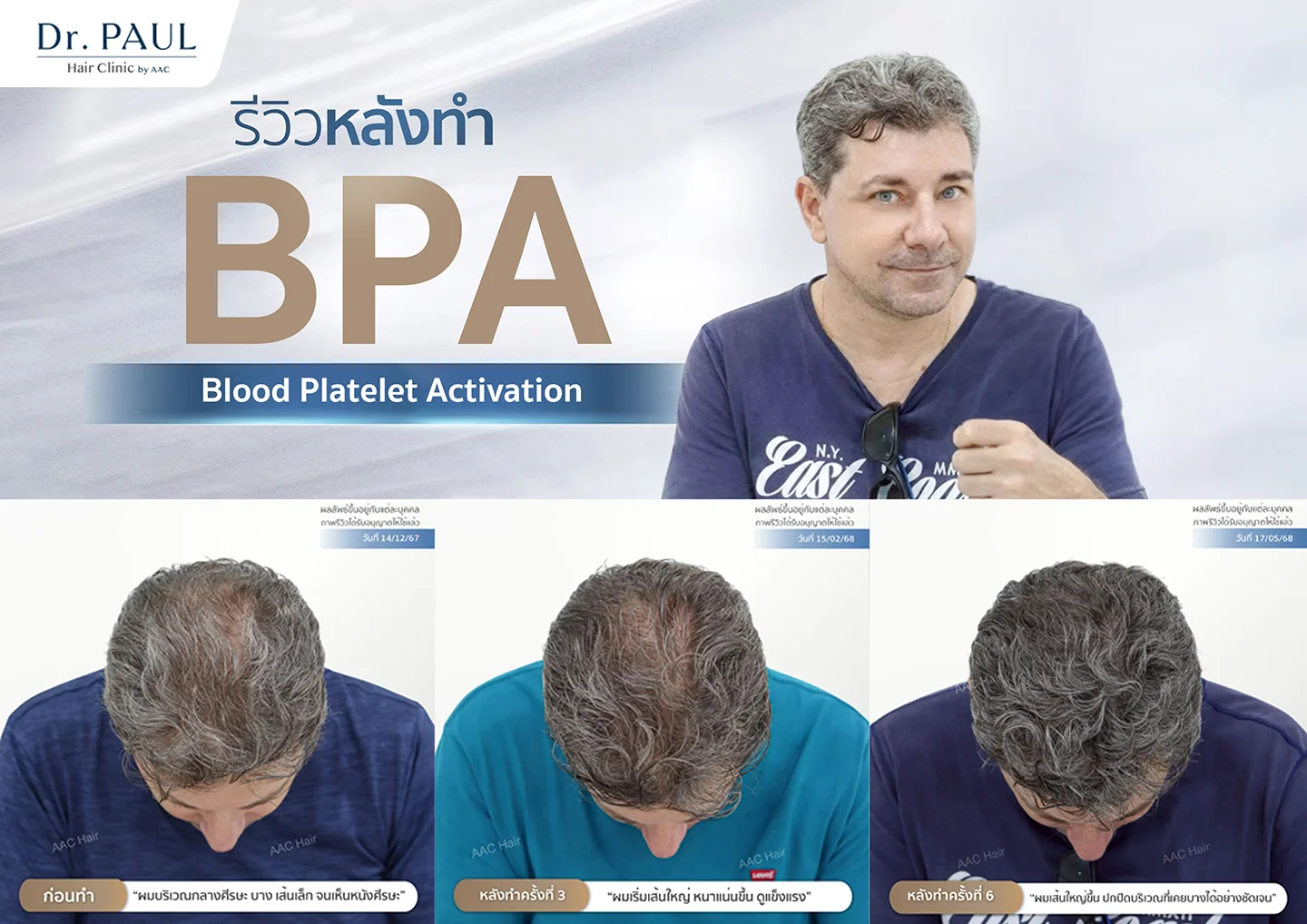 รีวิวโปรแกรม BPA บำรุงเส้นผม