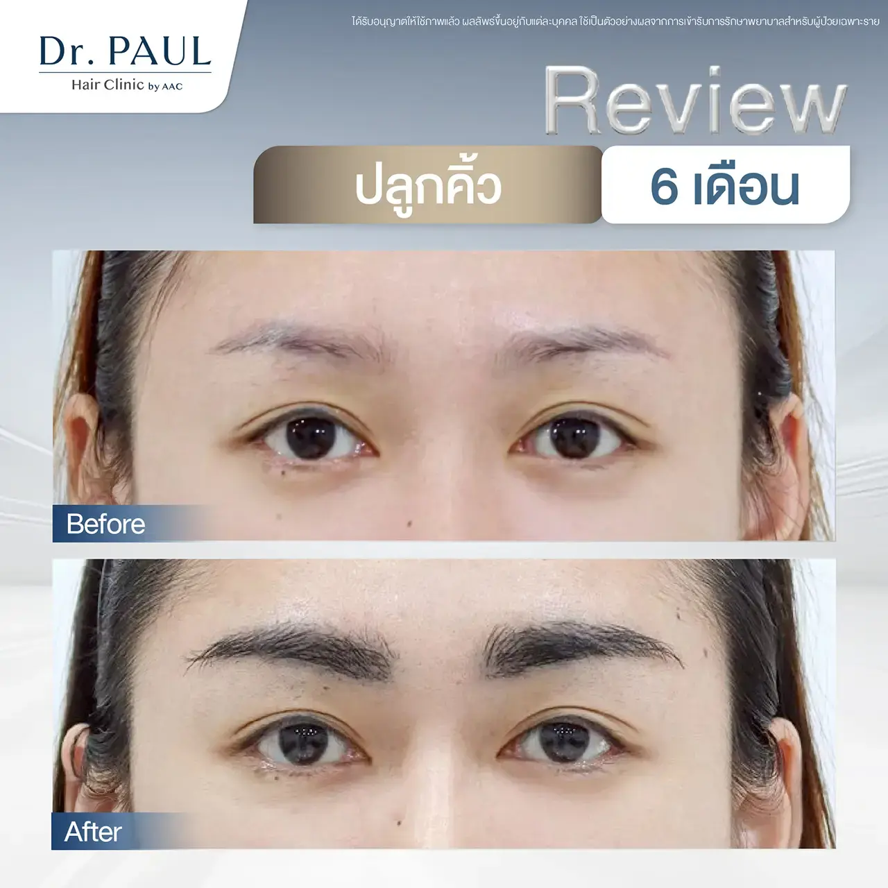 รีวิวปลูกคิ้วถาวร ผู้หญิง ครบ 6 เดือน