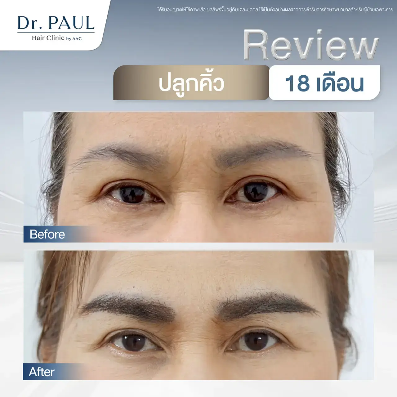 รีวิวหลังปลูกคิ้วถาวรในผู้หญิง เทียบก่อน-หลังปลูก 18 เดือน (1 ปีครึ่ง)