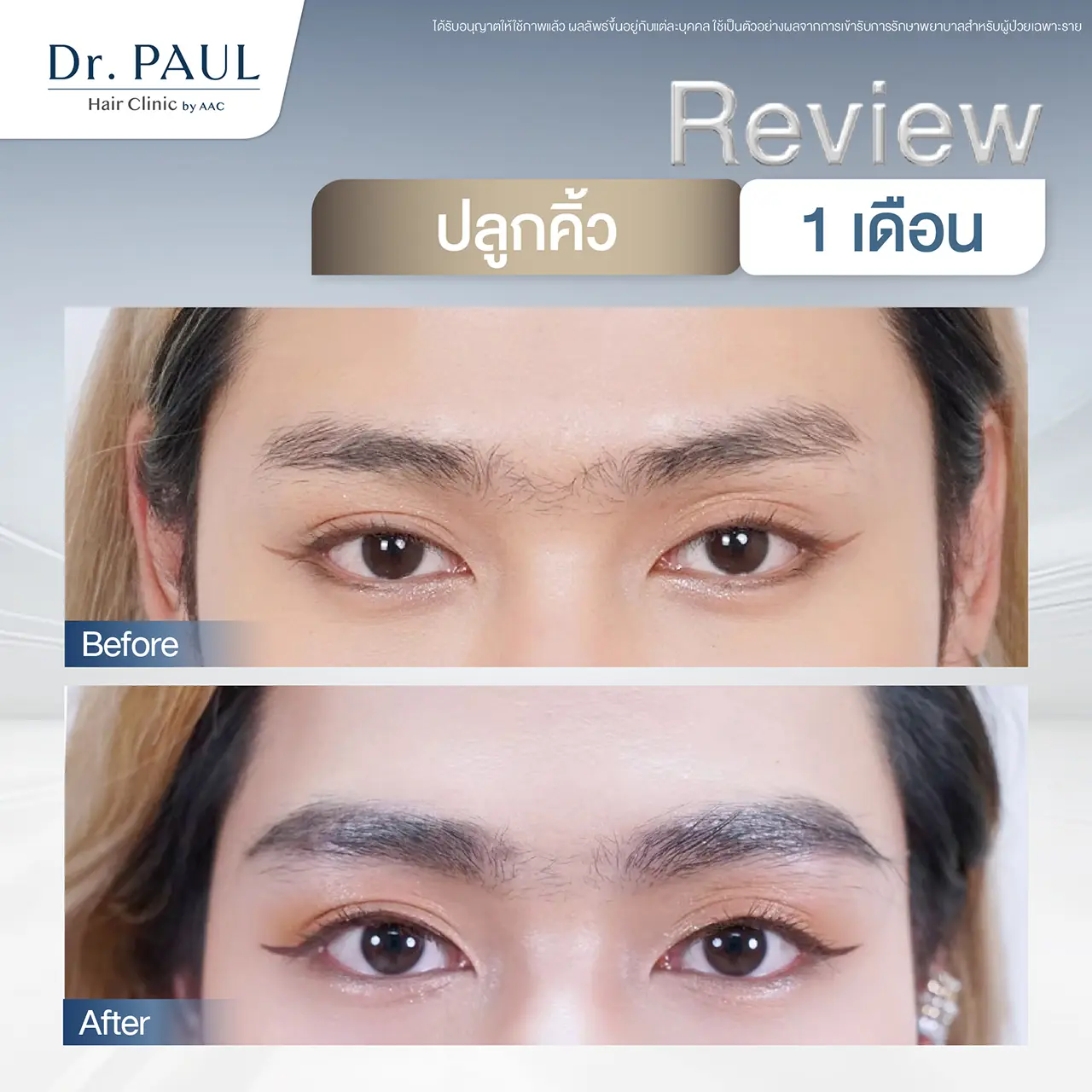 หลังปลูกคิ้ว 1 เดือนในผู้หญิง คิ้วเป็นทรง ดกหนาขึ้น