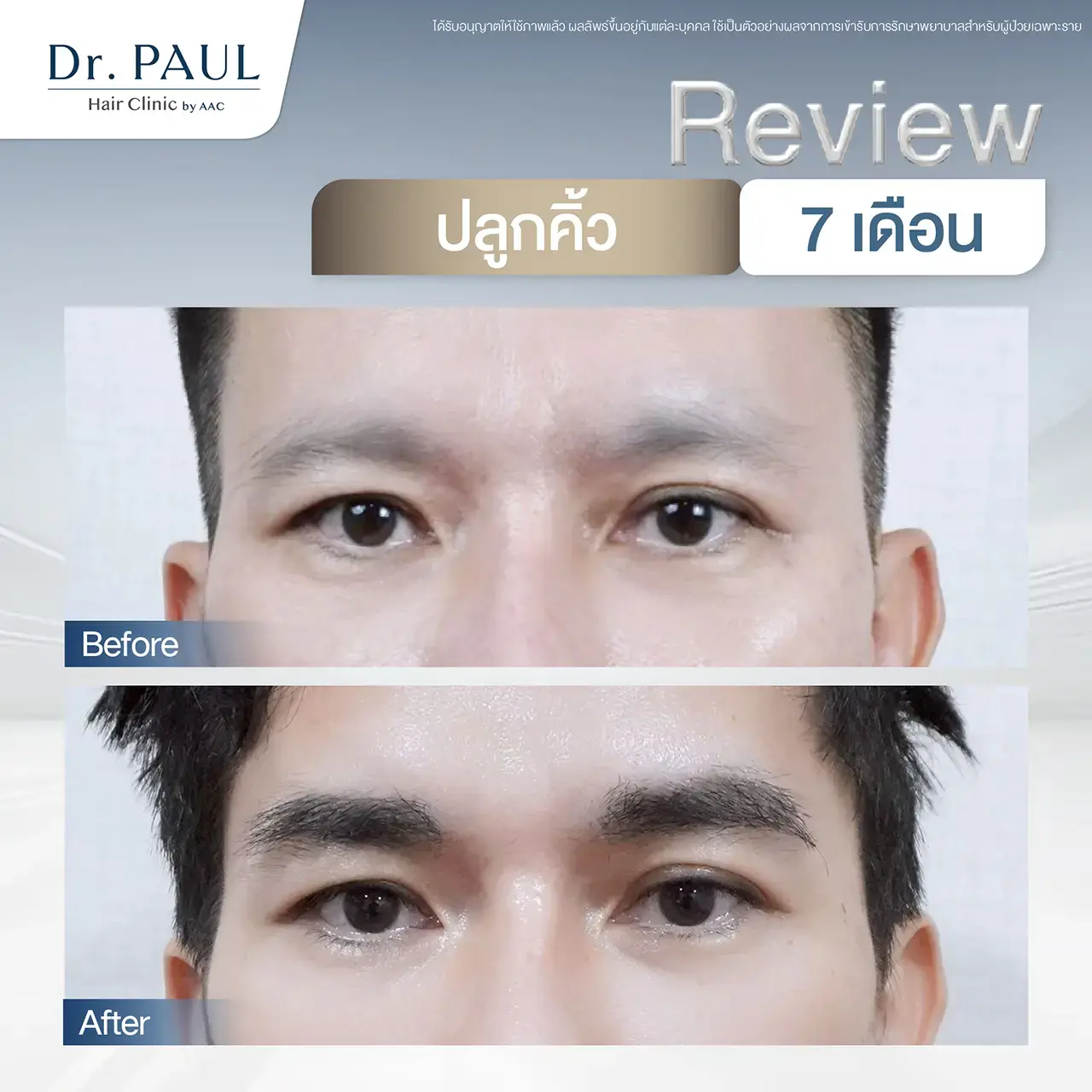 รีวิวปลูกคิ้วถาวร ผู้ชาย เทียบก่อน-หลัง 7 เดือน