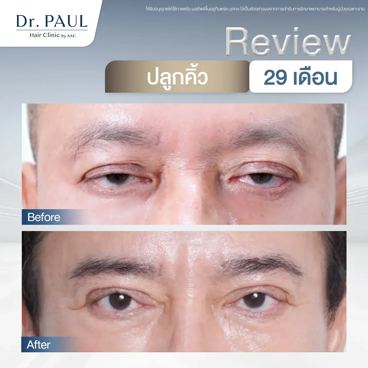รีวิวปลูกคิ้วในผู้ชาย เทียบก่อน-หลังปลูก 29 เดือน