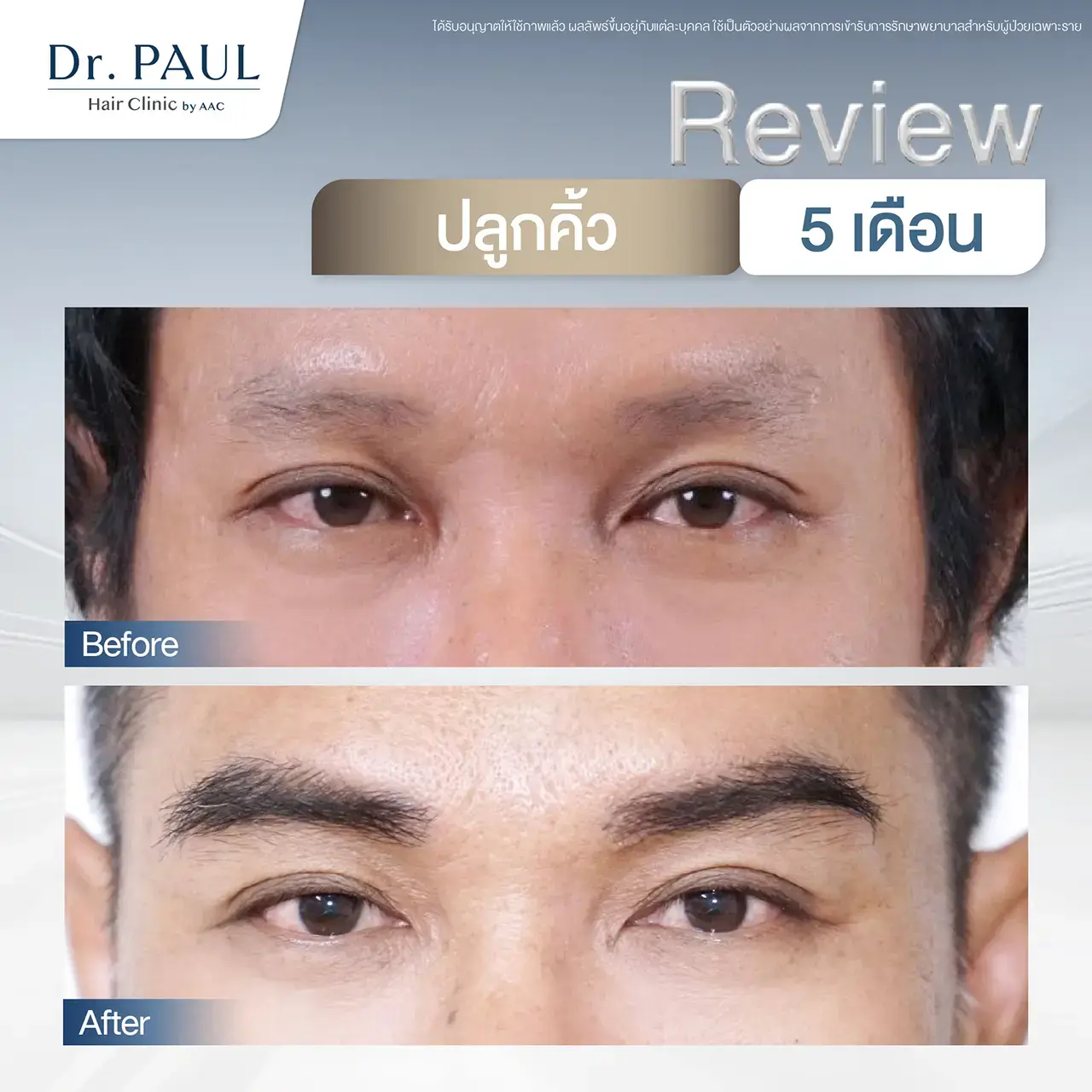 รีวิวผลลัพธ์หลังปลูกคิ้วถาวรในผู้ชาย 5 เดือน