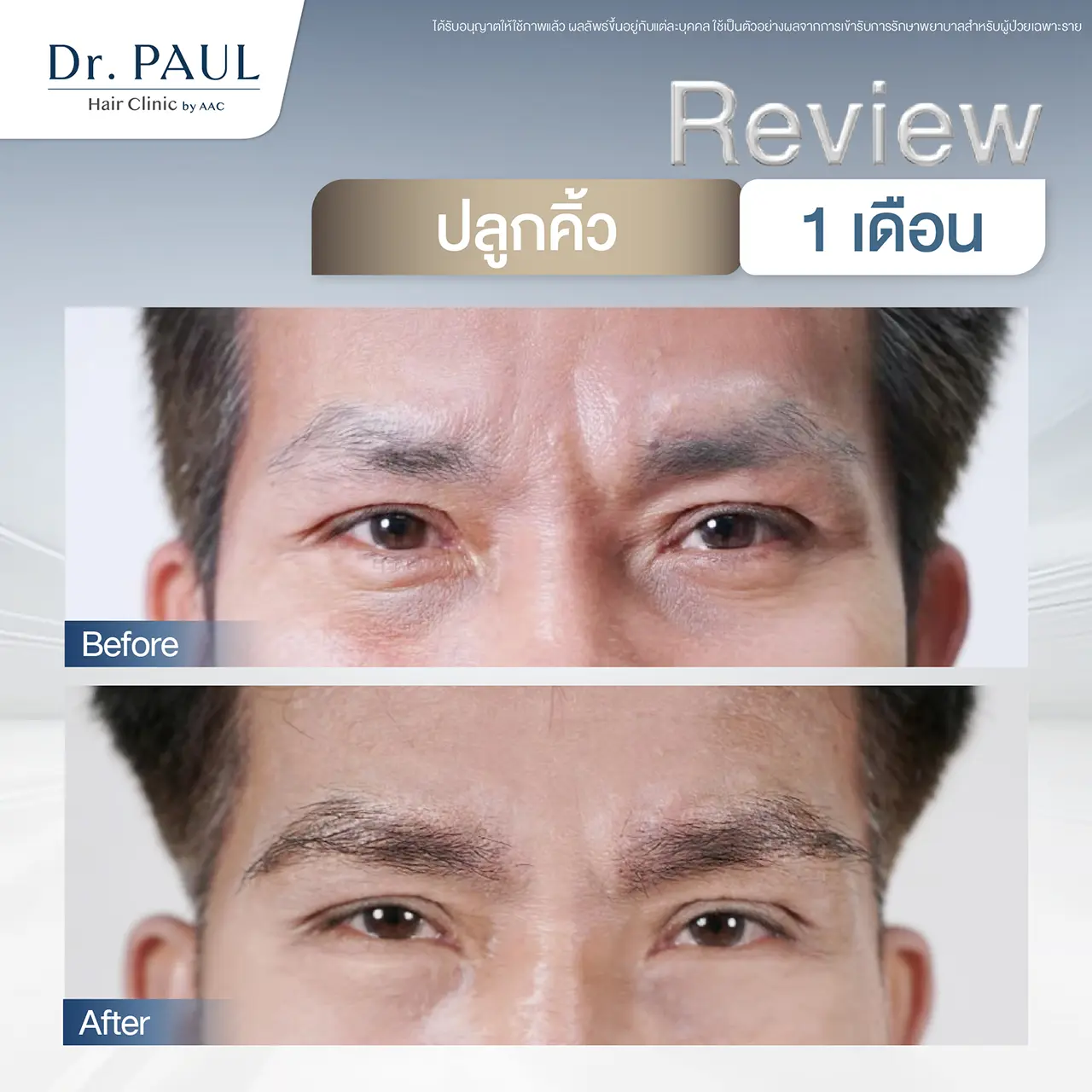 รีวิวหลังปลูกคิ้วถาวร 1 เดือน คิ้วดกหนาเป็นทรงมากขึ้น