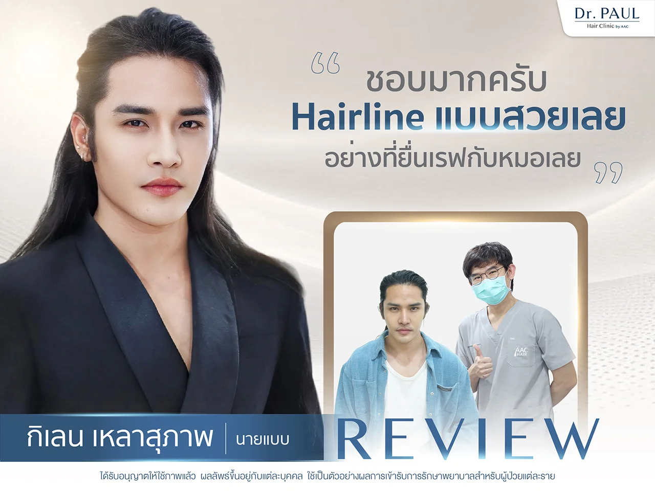 รีวิวปลูกผม กิเลน เหลาสุภาพ นายแบบ